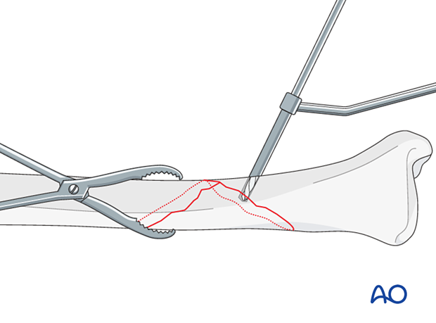 orif lag screws with protection plate - Lag screw insertion