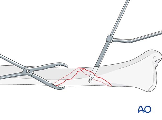 orif lag screws with protection plate - Lag screw insertion
