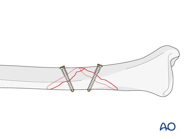 orif lag screws with protection plate - Lag screw insertion