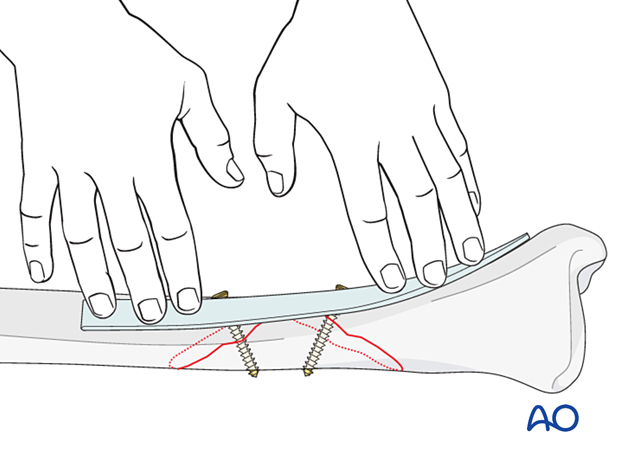 orif lag screws with protection plate – Plate preparation