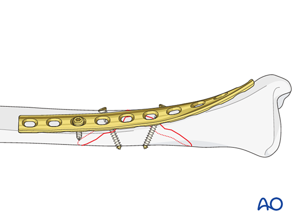 orif lag screws with protection plate – plate fixation