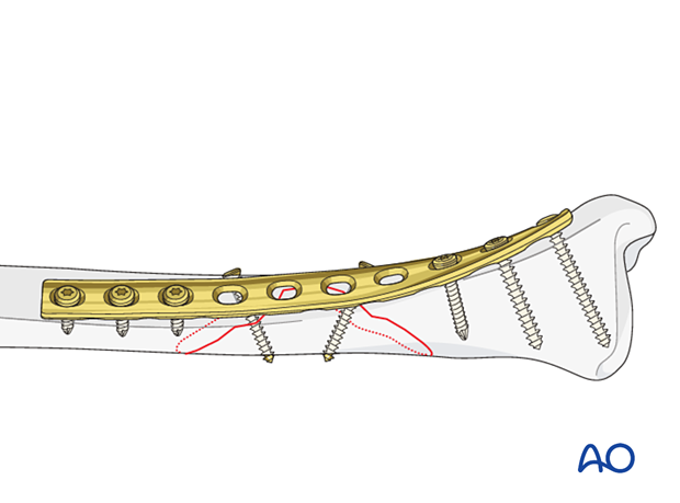 Tibial shaft intact wedge fracture: Lag screws with protection plate