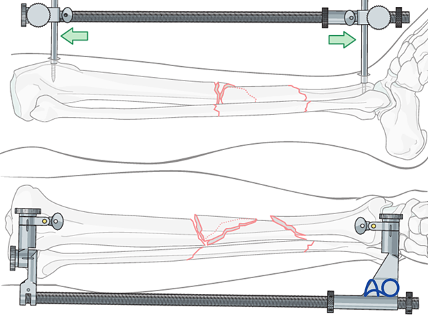 C2 tibial shaft fracture Large distractor or external fixator