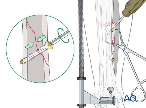 C2 tibial shaft fracture - Provisional fixation