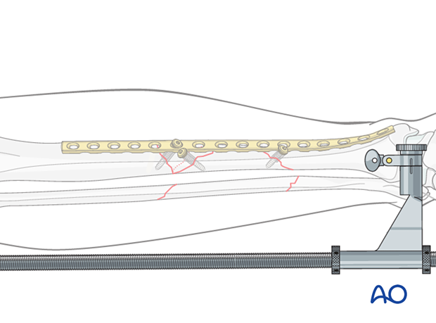 C2 tibial shaft fracture – plate application