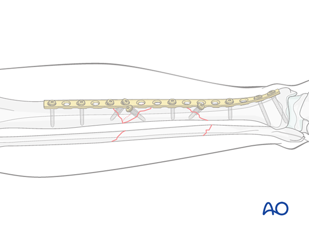 C2 tibial shaft fracture – plate fixation