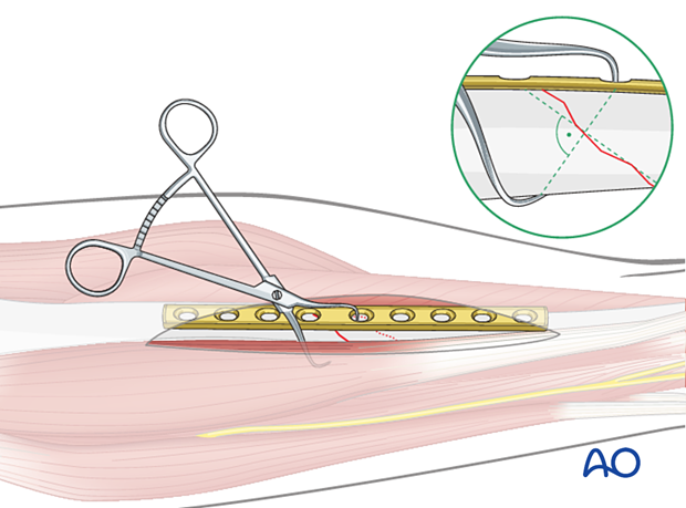 Reduction of the fracture