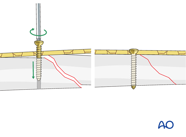 Indirect reduction with the plate
