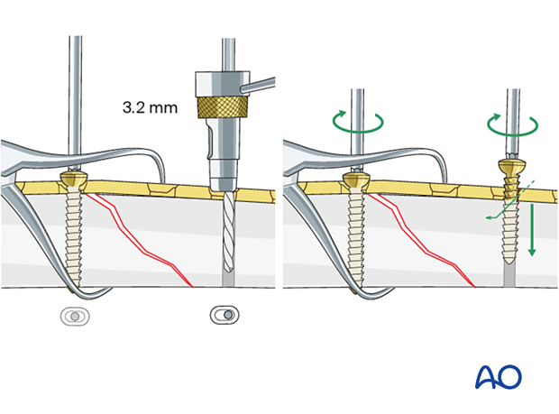 Axial compression with eccentric screw