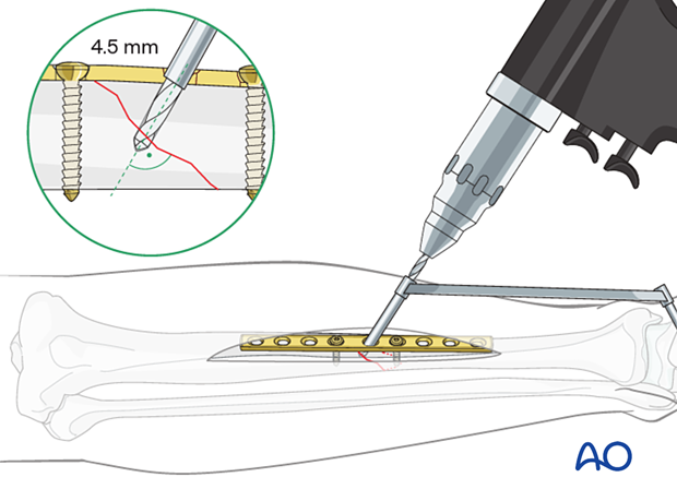 Drilling the gliding hole for the lag screw