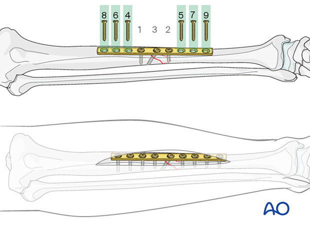Insertion of diaphyseal fixation screws