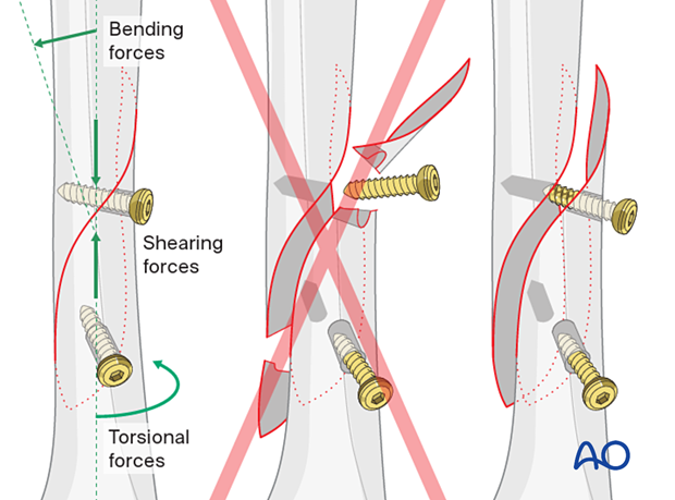 Bending, shearing and torsional forces may cause screw loosening