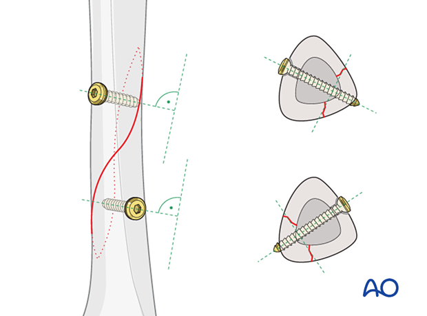 Tibial shaft simple fracture, spiral: screw position