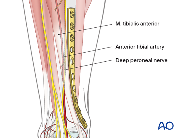 Tibial shaft simple fracture, spiral: Plate location