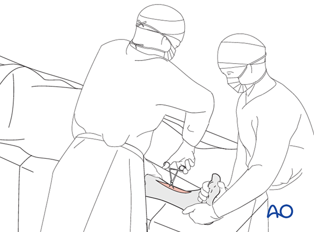 Tibial shaft fracture: open reduction