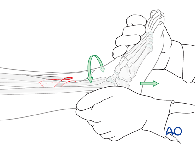 Tibial shaft simple fracture, spiral: Manual traction