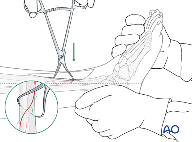 Tibial shaft simple fracture, spiral: Reduction of the fracture