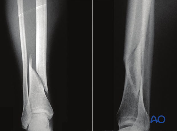 Tibial shaft simple fracture, spiral: Assessing the fracture plane