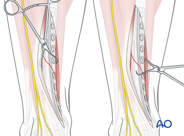Tibial shaft simple fracture, spiral: Provisional fixation