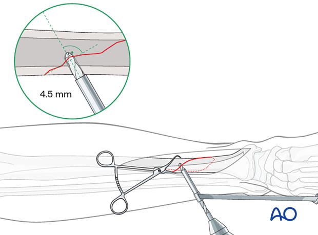 Tibial shaft simple fracture, spiral: Drilling the gliding hole