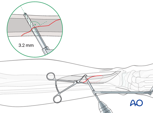 Tibial shaft simple fracture, spiral: Drilling the thread hole