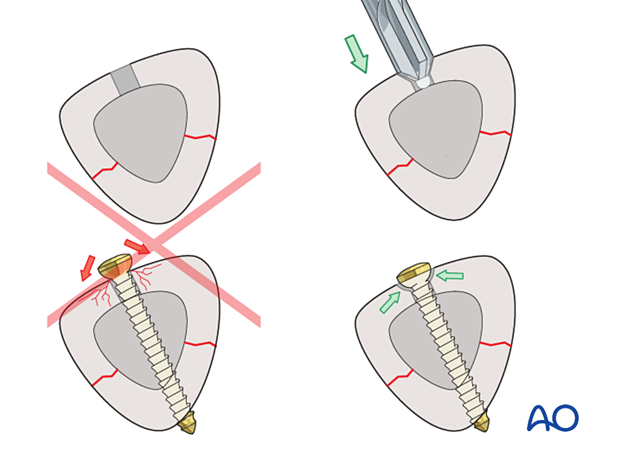 Tibial shaft simple fracture: Countersinking in diaphyseal bone
