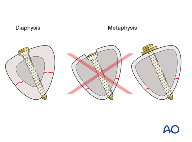 Tibial shaft simple fracture: No countersinking in the metaphysis