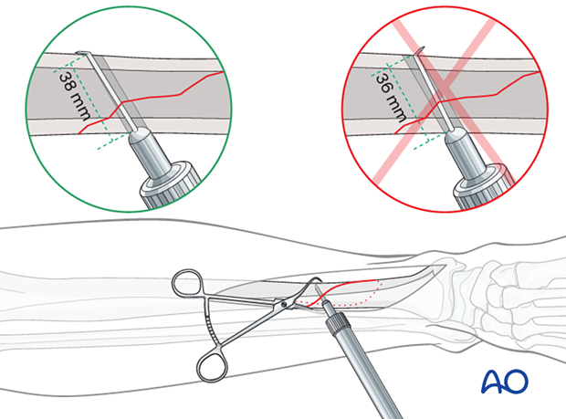 Tibial shaft simple fracture, spiral: Measuring for screw length