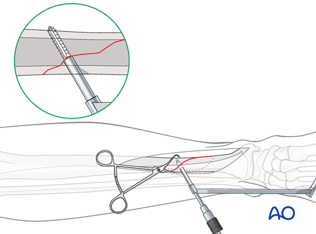 Tibial shaft simple fracture, spiral: Tapping the thread hole