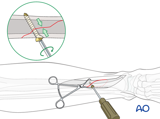 Tibial shaft simple fracture, spiral: Lag screw insertion