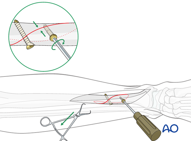 Tibial shaft simple fracture, spiral: Insertion of the second lag screw