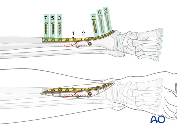 Tibial shaft simple fracture, spiral: Insertion of diaphyseal plate screws