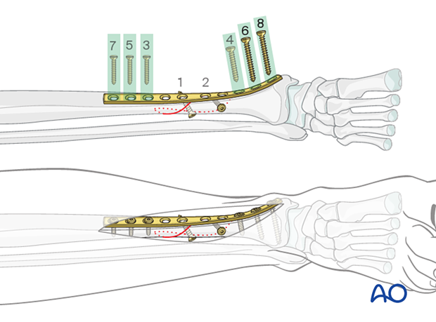 Tibial shaft simple fracture, spiral: Insertion of metaphyseal plate screws
