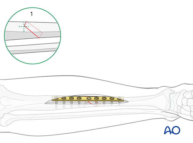 Tibial shaft simple fracture, oblique: Axial compression plate with a supplementary lag screw through the plate