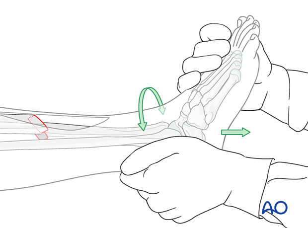 Tibial shaft simple fracture, oblique: Manual traction