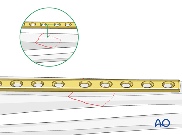 Tibial shaft simple fracture, oblique: Confirming fracture plane