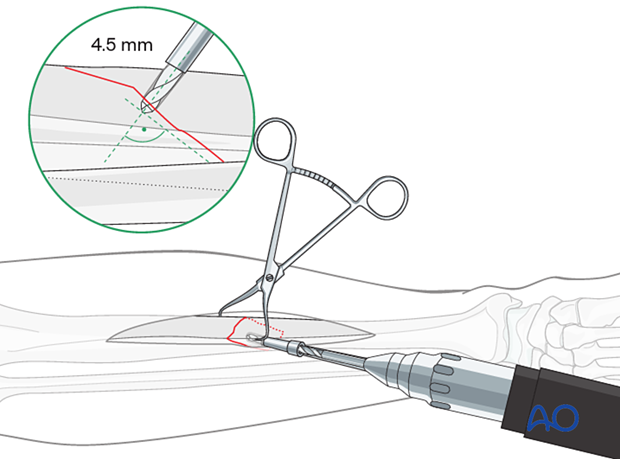 Tibial shaft simple fracture, oblique: Drilling the gliding hole