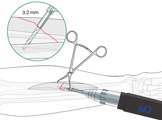 Tibial shaft simple fracture, oblique: Drilling the thread hole