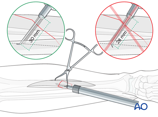 Tibial shaft simple fracture, oblique: Measuring for screw length