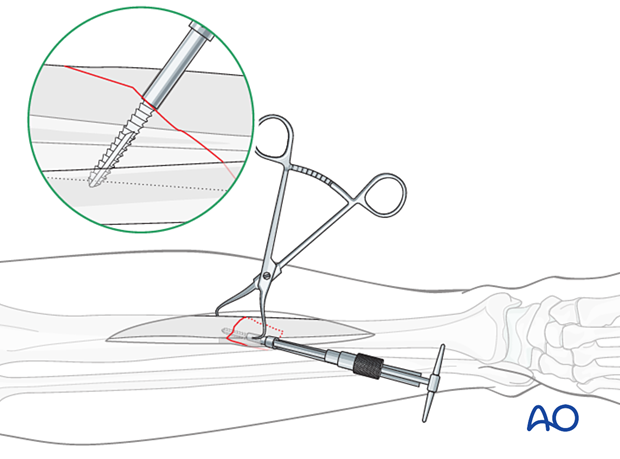 Tibial shaft simple fracture, oblique: Tapping the thread hole