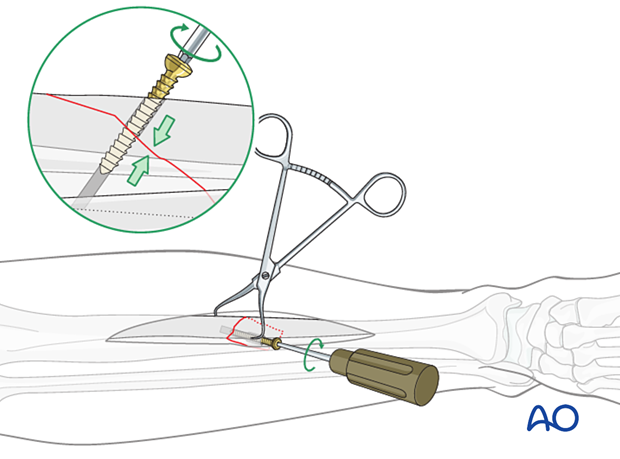 Tibial shaft simple fracture, oblique: Insertion of the lag screw
