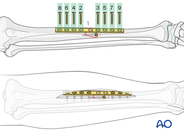 Tibial shaft simple fracture, oblique: Plate preparation and fixation