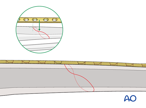 Tibial shaft simple fracture, spiral: Confirm fracture plane