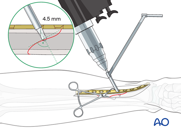 Tibial shaft simple fracture, spiral: Gliding hole drilled through plate