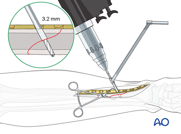 42 P130A1 ORIF Lag screws through protection plate