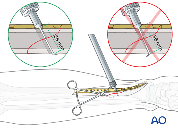 Tibial shaft simple fracture, spiral: Measuring for screw length