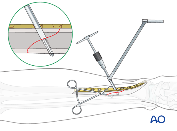 Tibial shaft simple fracture, spiral: Tapping the thread hole