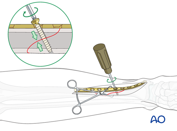 Tibial shaft simple fracture, spiral: Lag screw insertion
