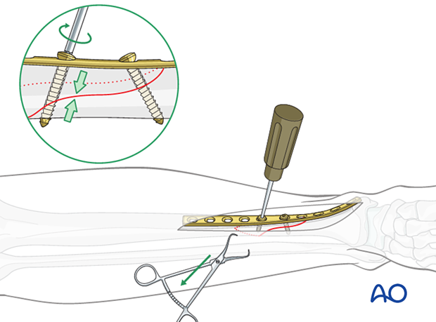 Tibial shaft simple fracture, spiral: Insertion of the second lag screw