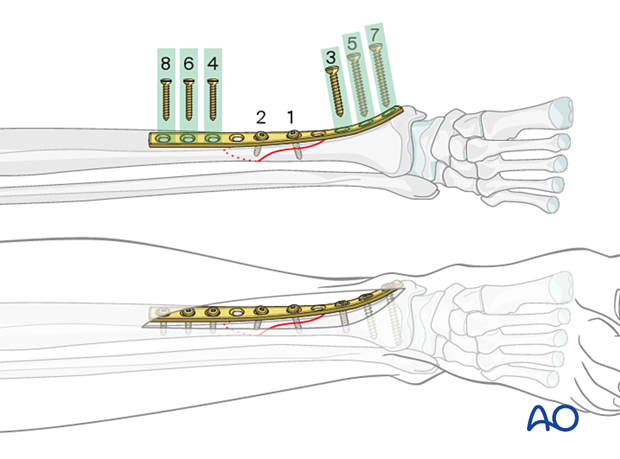 Tibial shaft simple fracture, spiral: Insertion of diaphyseal fixation screws